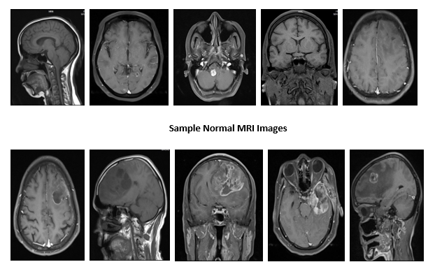 mri scan brain normal